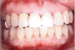 �m���N���X�v�`��